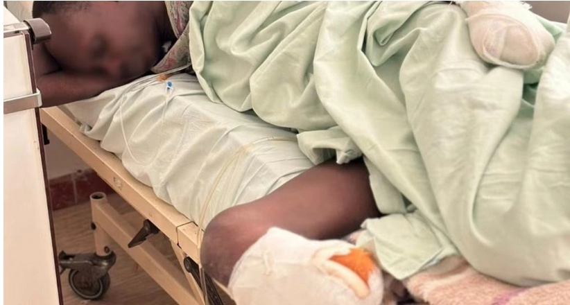 'Te ruke su trebale donijeti kruh': Sudancima zbog promrzlina u BiH amputirane potkoljenice i dijelovi ruku